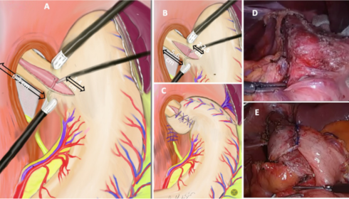 fundoplication